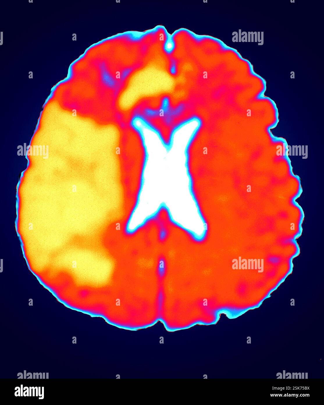 Bacterial Pneumonia X Ray