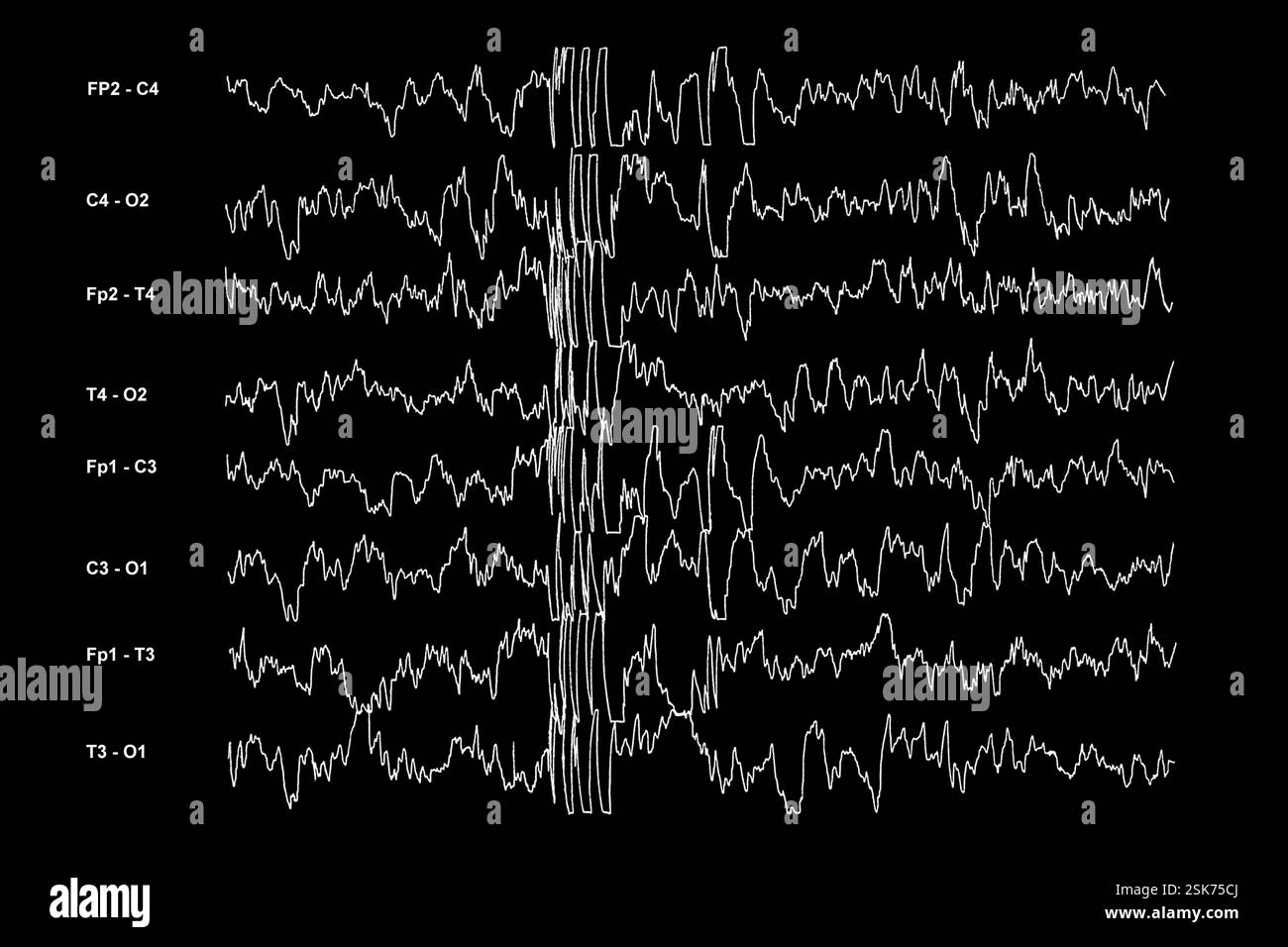 Slipped disc, MRI scan Stock Photo - Alamy