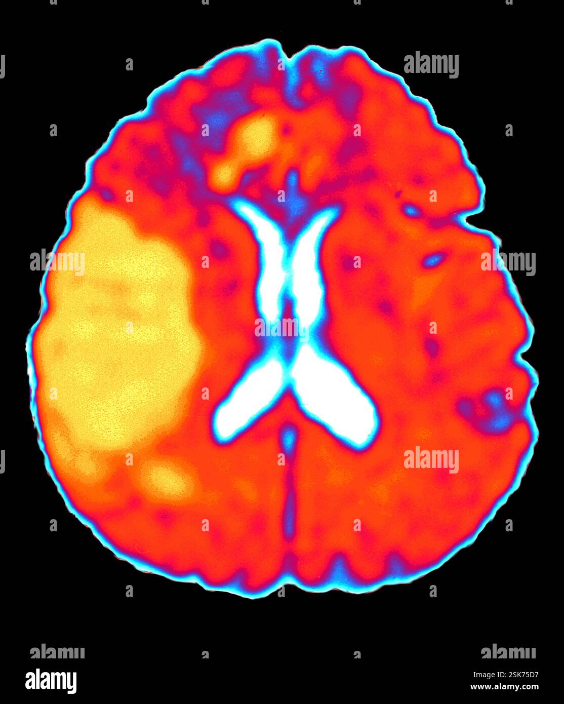 Bacterial pneumonia x ray stock photo alamy
