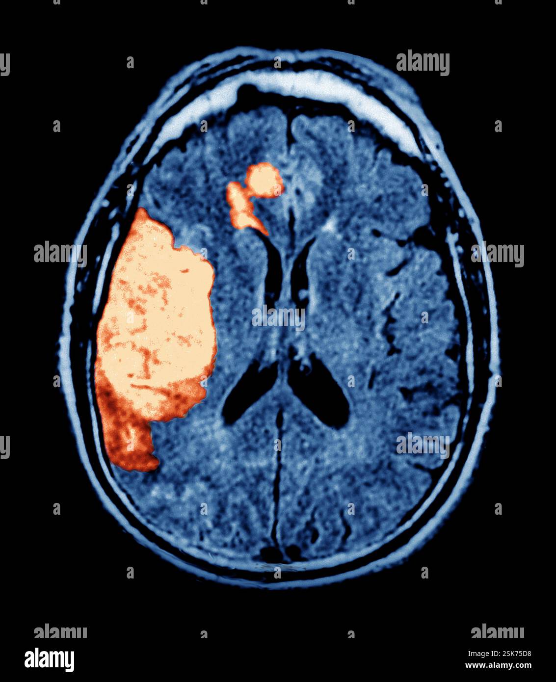 Bacterial pneumonia x ray stock photo alamy