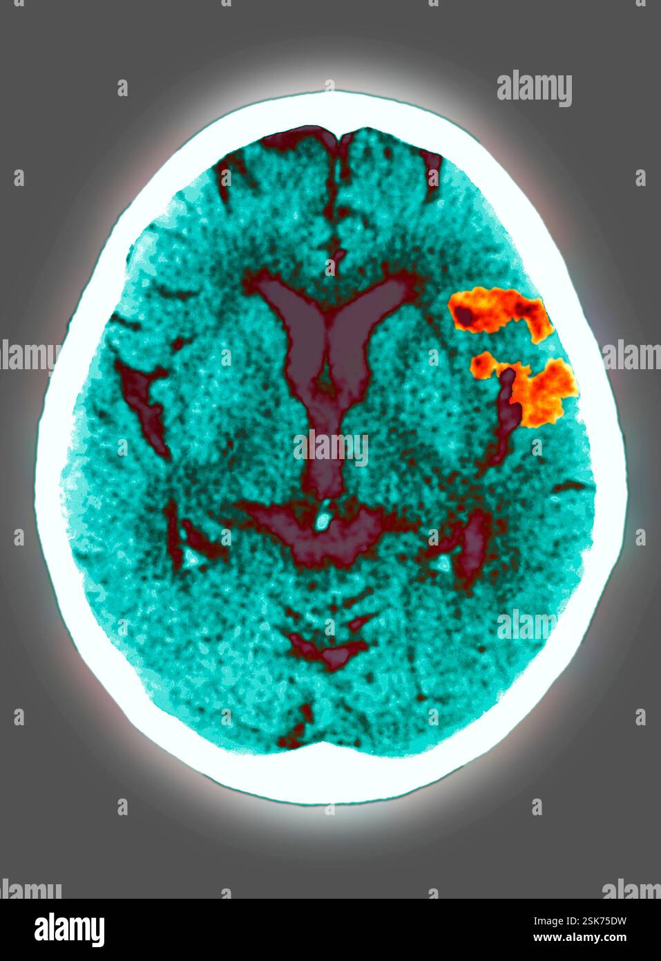 Bacterial pneumonia x ray stock photo alamy