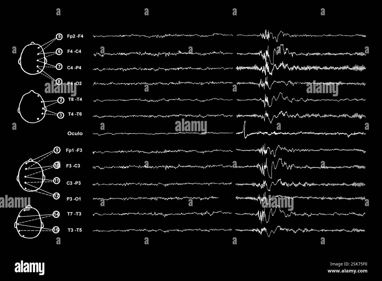 Brain waves during sleep. Electroencephalogram (EEG) of a person during ...
