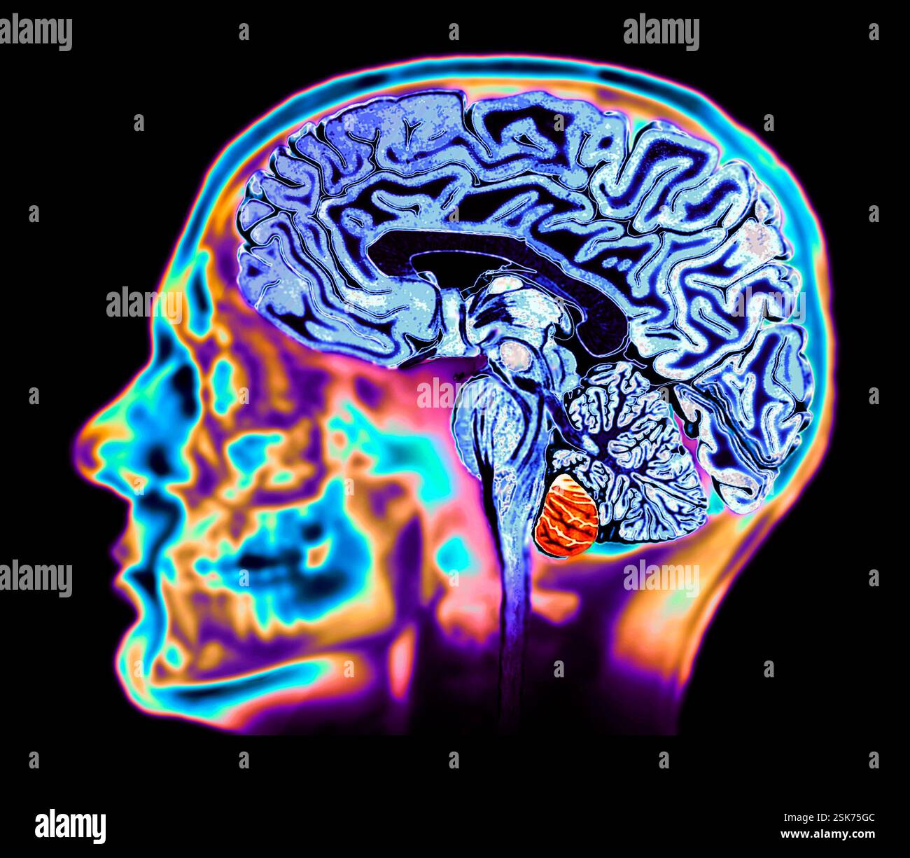 Healthy brain. Coloured magnetic resonance imaging (MRI) scan of a ...