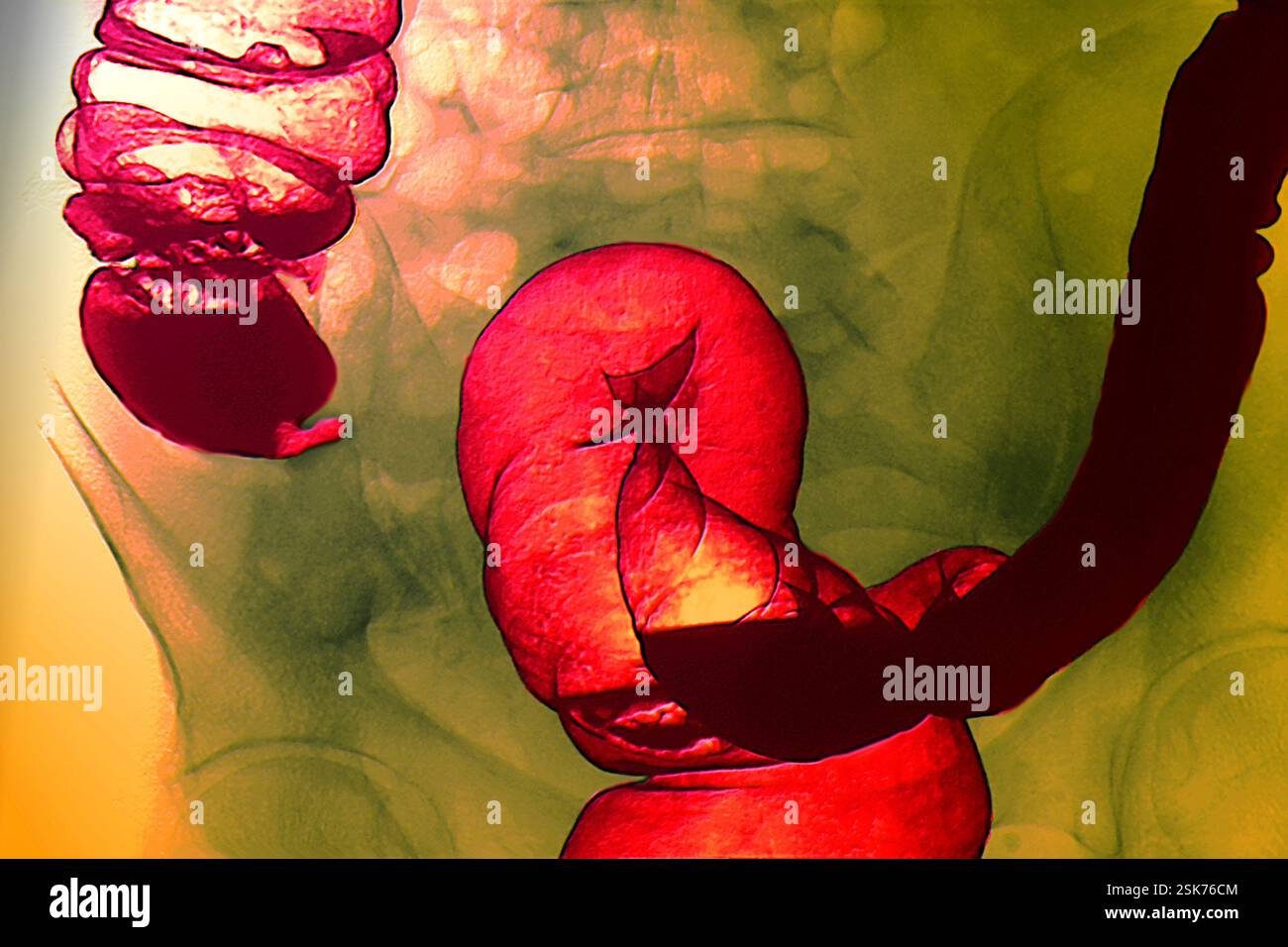 Healthy appendix, barium enema X-ray Stock Photo - Alamy