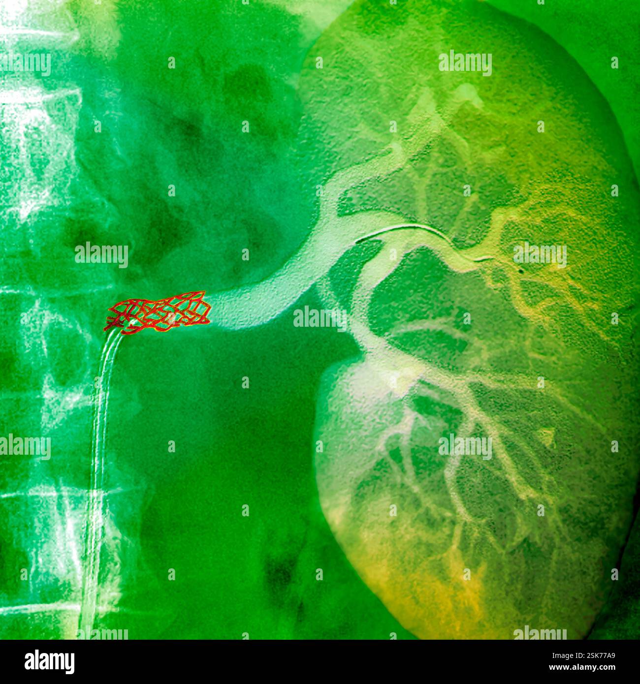 Arterial stent. Coloured X-ray angiogram of a stent (brown, left) in the left renal artery of a 68-year-old man. The spine is seen at left. The stent, a wire mesh tube, is being used to treat ostial stenosis (narrowing) of the artery. It holds the artery open and restores normal blood flow. The most common cause of stenosis is atheroma, fatty deposits that thicken the inner coat of the arteries. Stock Photo