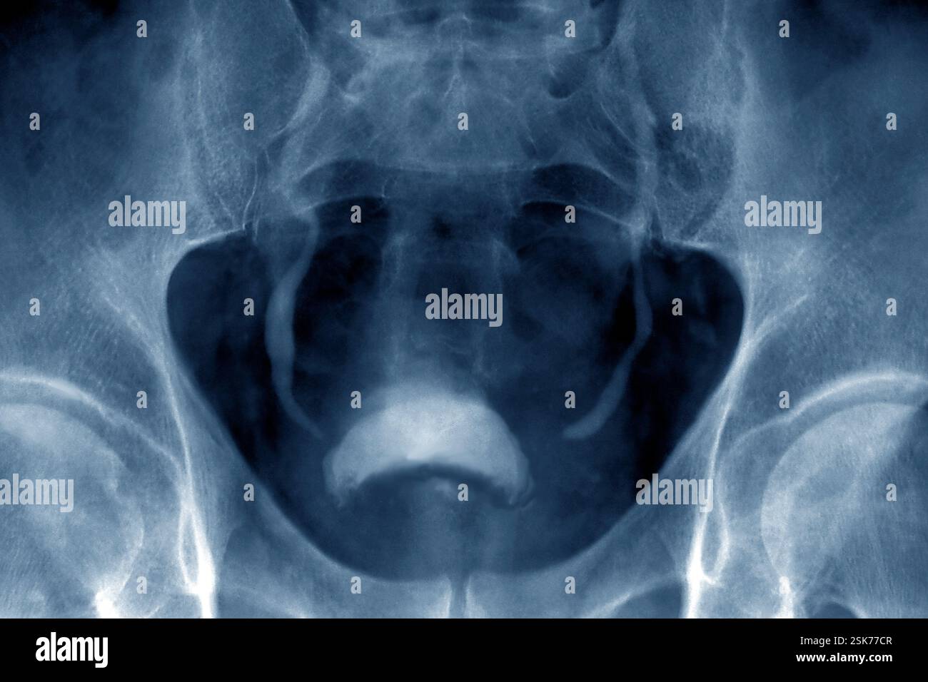 Prostate cancer. Coloured urogram (X-ray) of the pelvis of a male ...