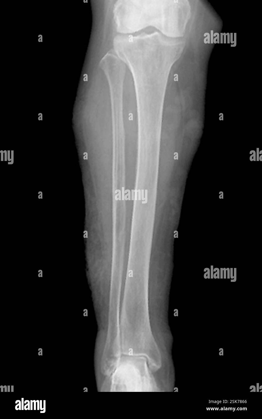 X-ray (front view) of the lower leg of a female patient aged 90 ...