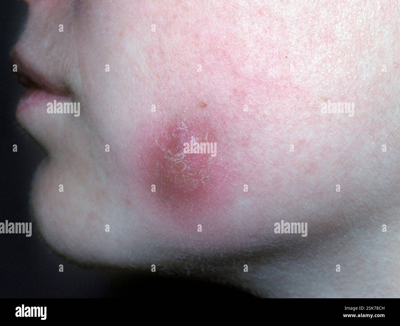 Close-up of the cheek of a 14 year old male patient, showing cellulitis ...