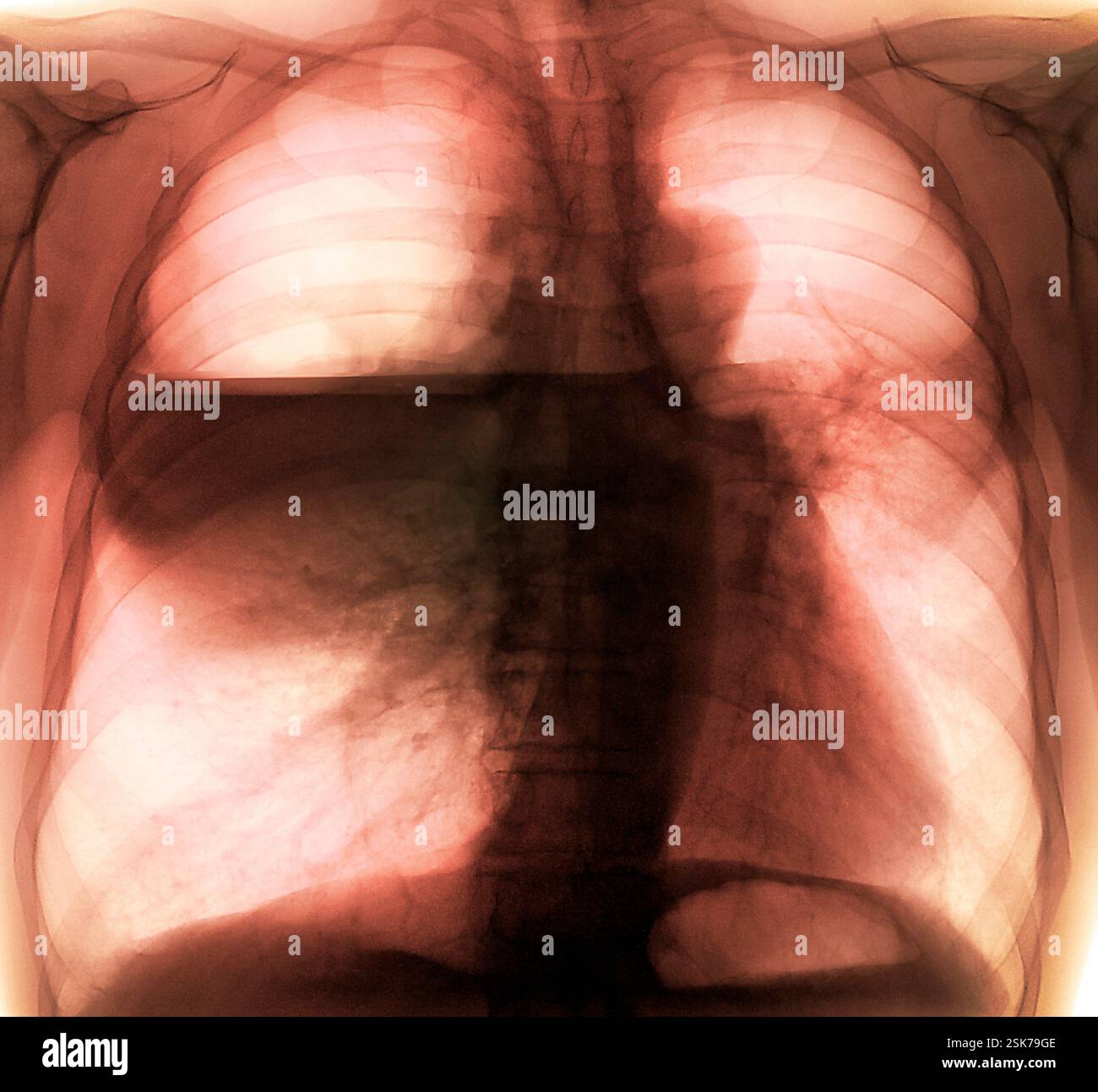 Coloured X-ray (front view) of the chest in a 53 year old male patient ...