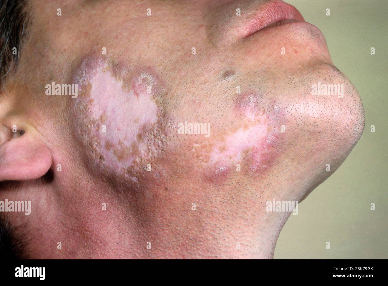 Systemic lupus erythematosus (SLE) rash on the skin of the face in a ...