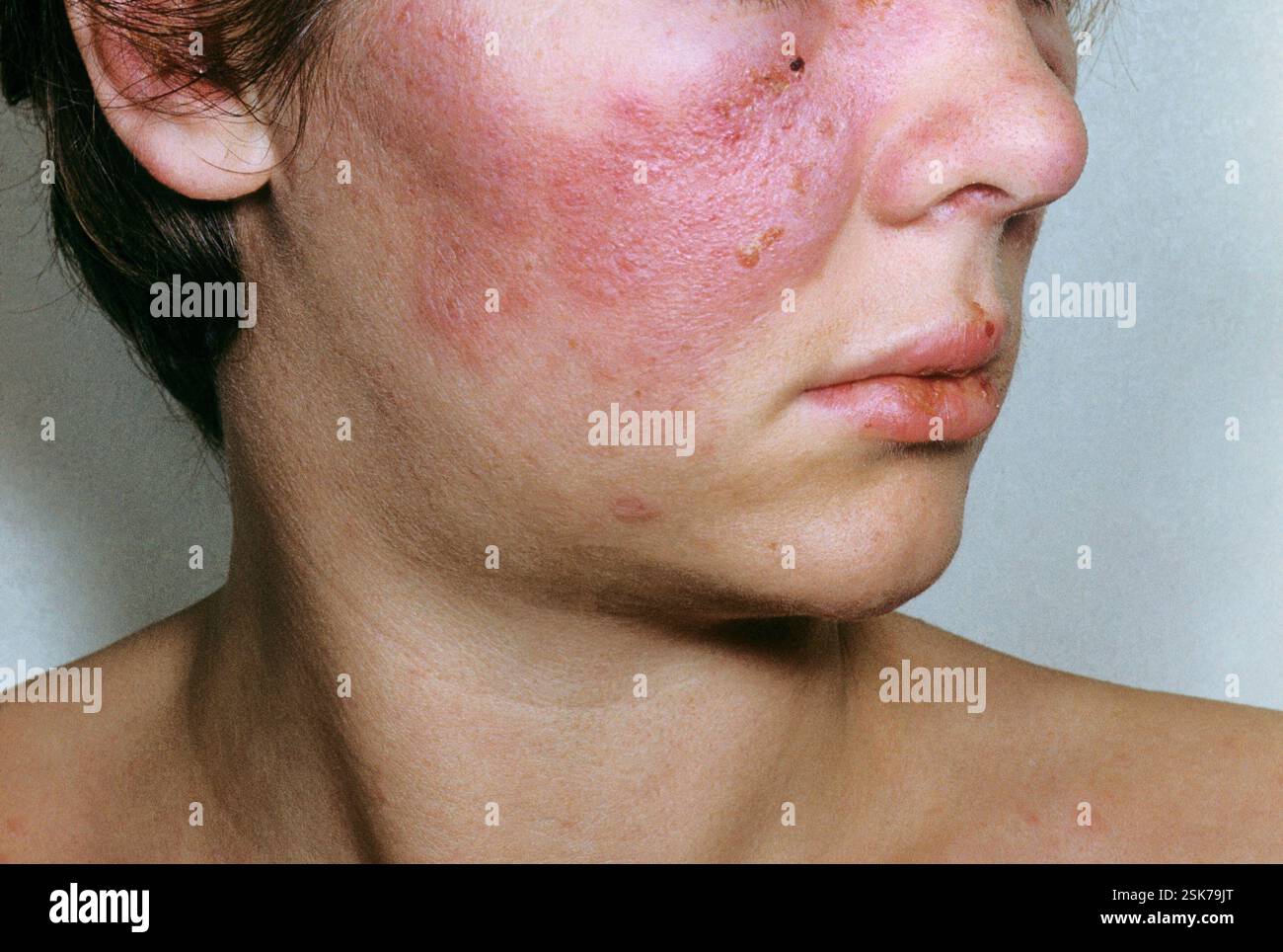 Systemic lupus erythematosus (SLE) rash on the skin of the face in a ...