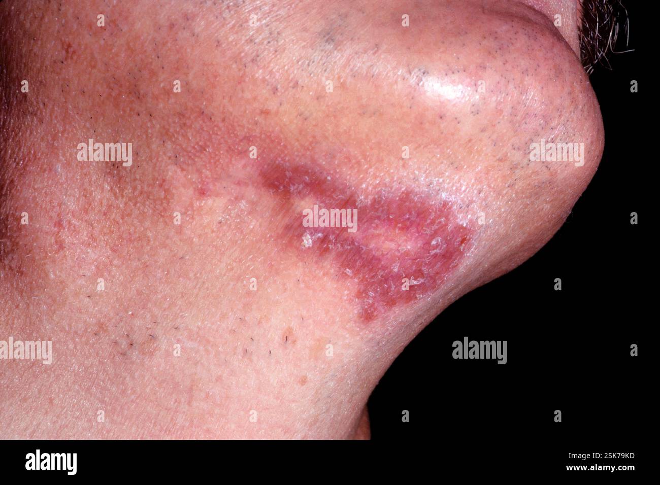 Secondary lymph node cancer, CT and PET scan Stock Photo - Alamy