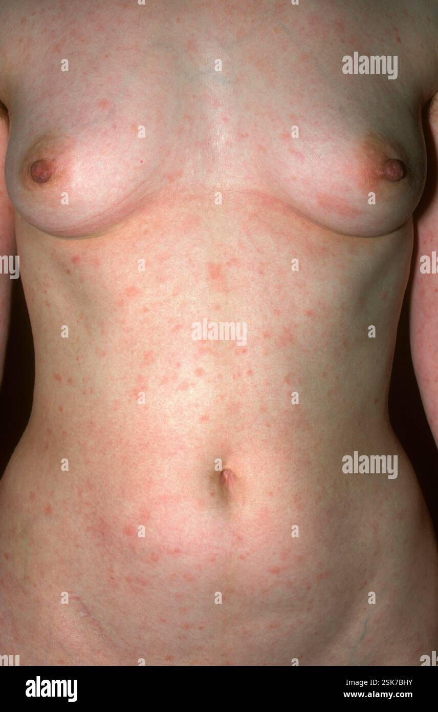 Sle Mask Rash on the body of a 24-year-old female patient with systemic lupus ...