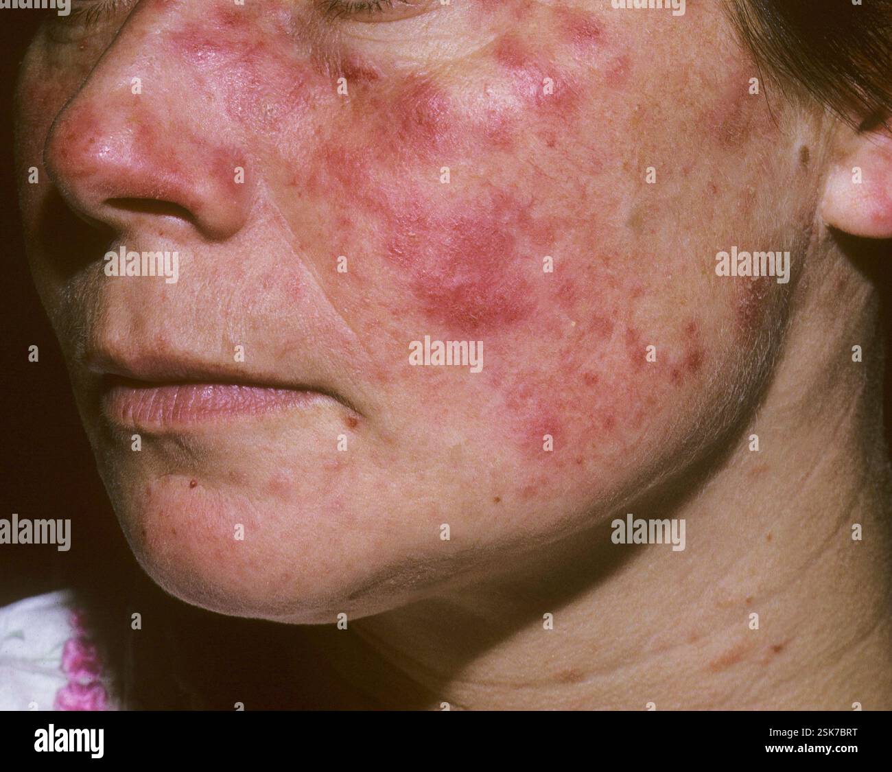 Lupus erythematosus. Close-up of a rash on the face of a 45-year-old ...