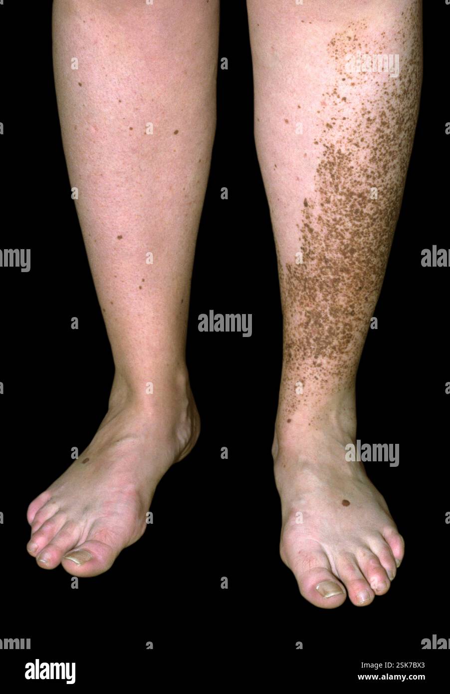 Verrucous epidermal hamartoma. Close-up of a rash on the left leg ...