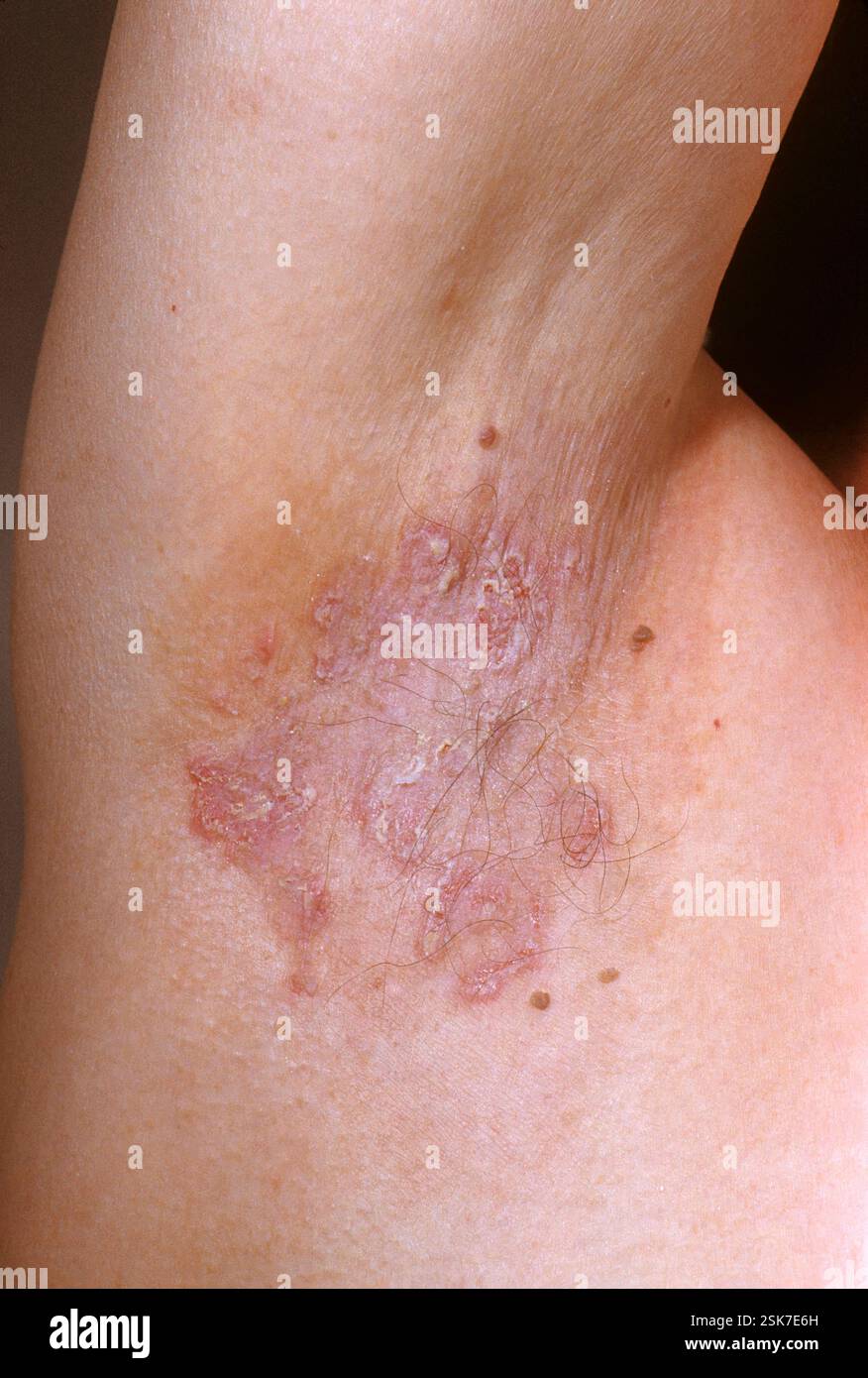 Hailey Hailey Disease Skin Lesion In The Right Armpit Of A 61 year old hailey-hailey-disease-skin-lesion-in-the-right-armpit-of-a-61-year-old