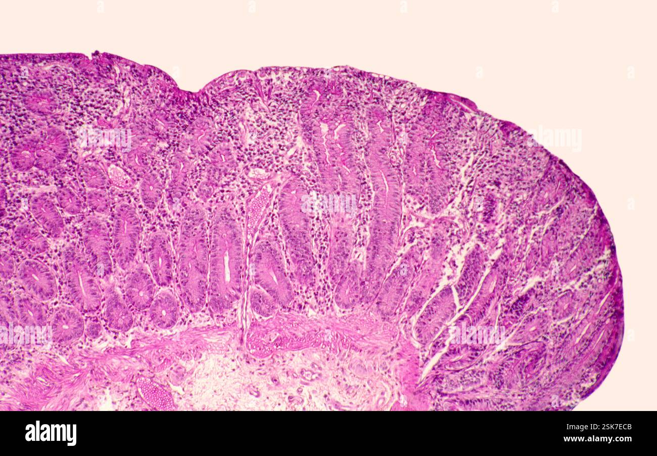 Paget's disease of the skull, CT scan and SPECT scan Stock Photo - Alamy
