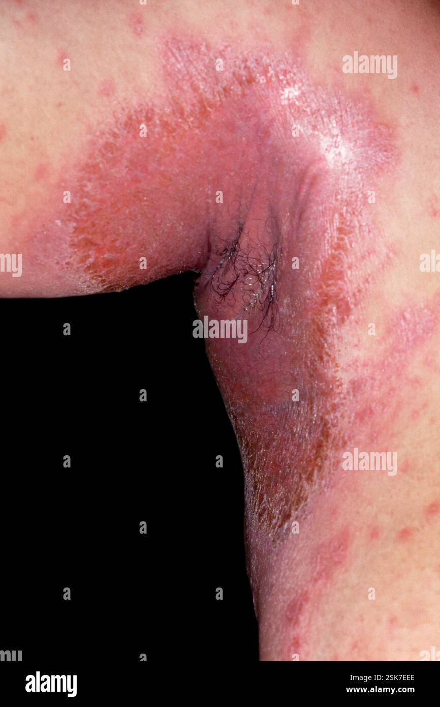 Weeping Rashes Infected eczema rash in the armpit of a 45 year old female patient ...