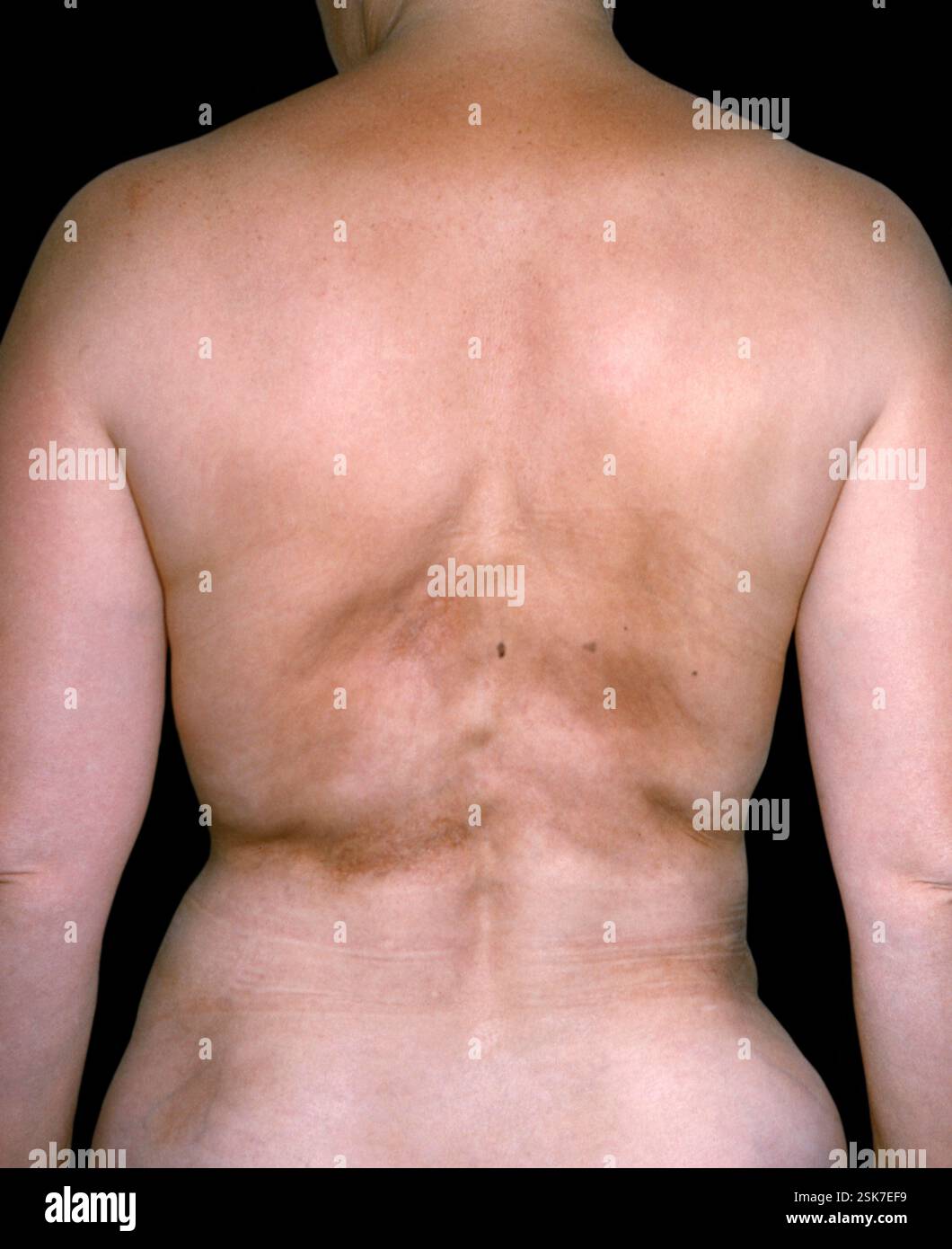 Atrophoderma of Pasini and Pierini on the back of a 62 year old female ...
