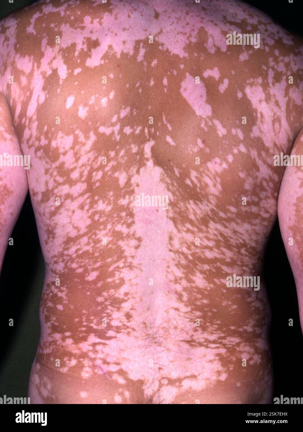 Irregular Skin Vitiligo on a 30 year old black man's back. Vitiligo (leukoderma) is a ...