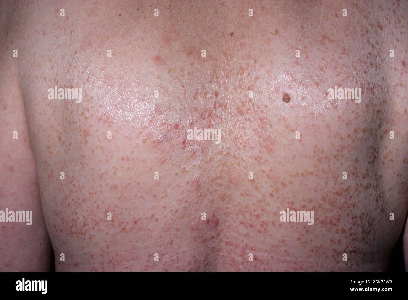 Pityriasis lichenoides chronica lesions on the skin of a 30 year old ...