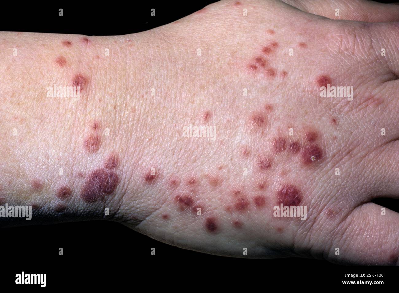 Diffuse large B-cell lymphoma, composite CT and PET scan Stock Photo ...