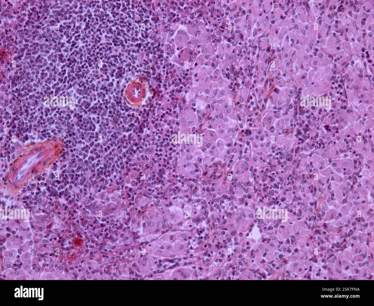 Hodgkin lymphoma recurrence, CT and PET scans Stock Photo