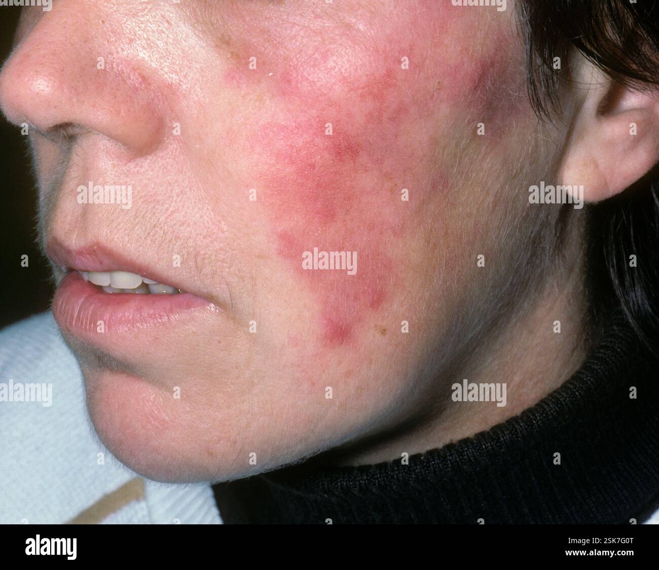 Lupus tumidus rash on the face of a 43 year old female patient with