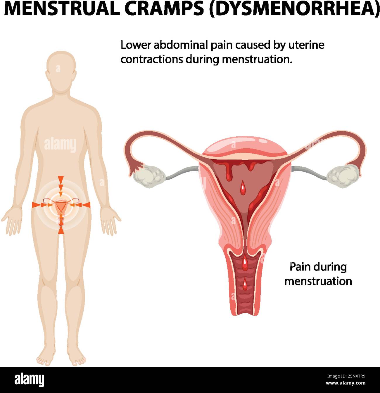 Illustration of menstrual pain and uterine anatomy Stock Vector Image ...