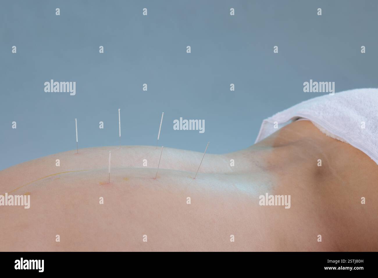 Close up Of A Dry Needling Session Where A Practitioner Inserts Thin 