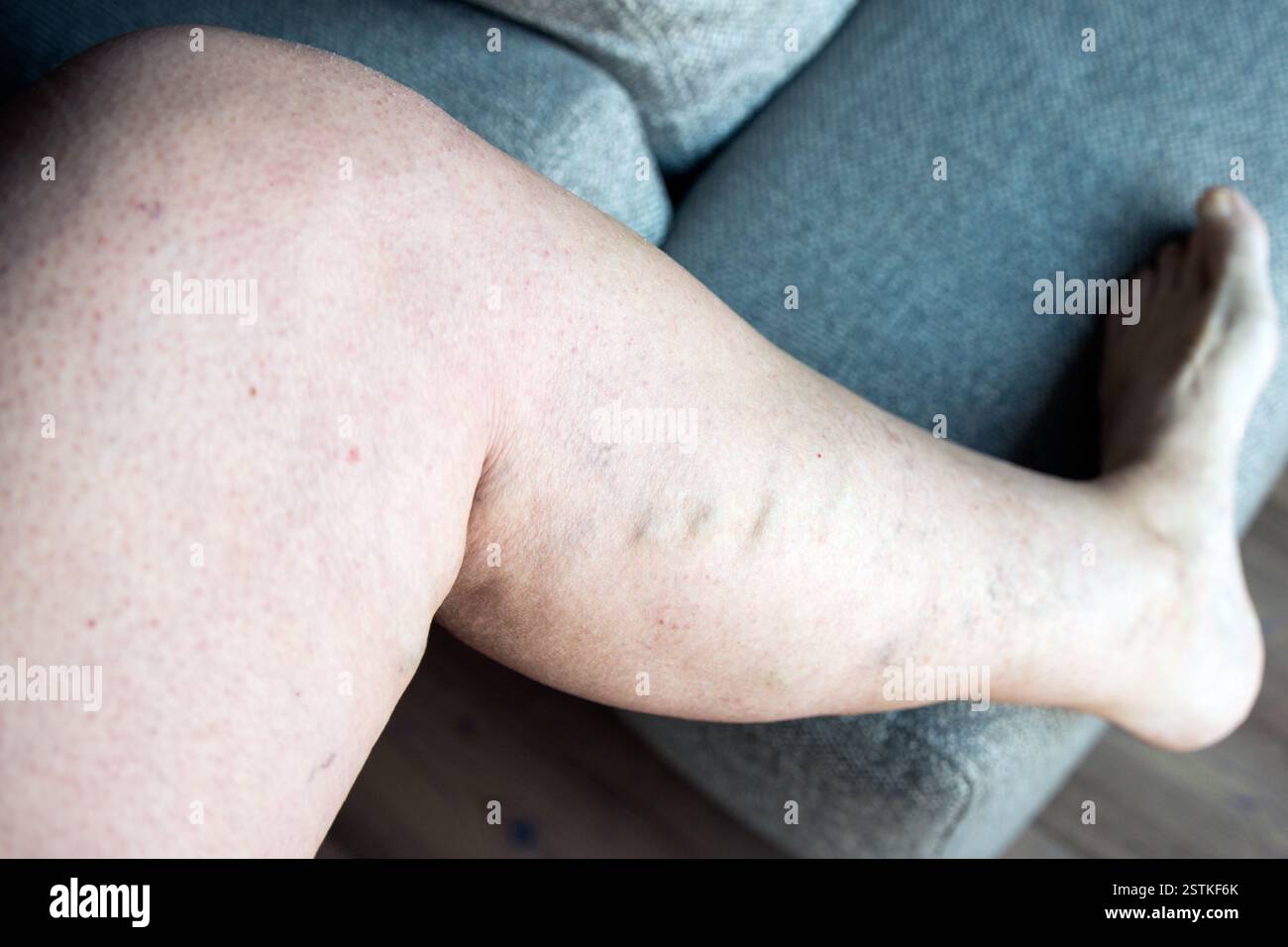 Caucasian woman with varicose saphenus vein. Reflux Stock Photo