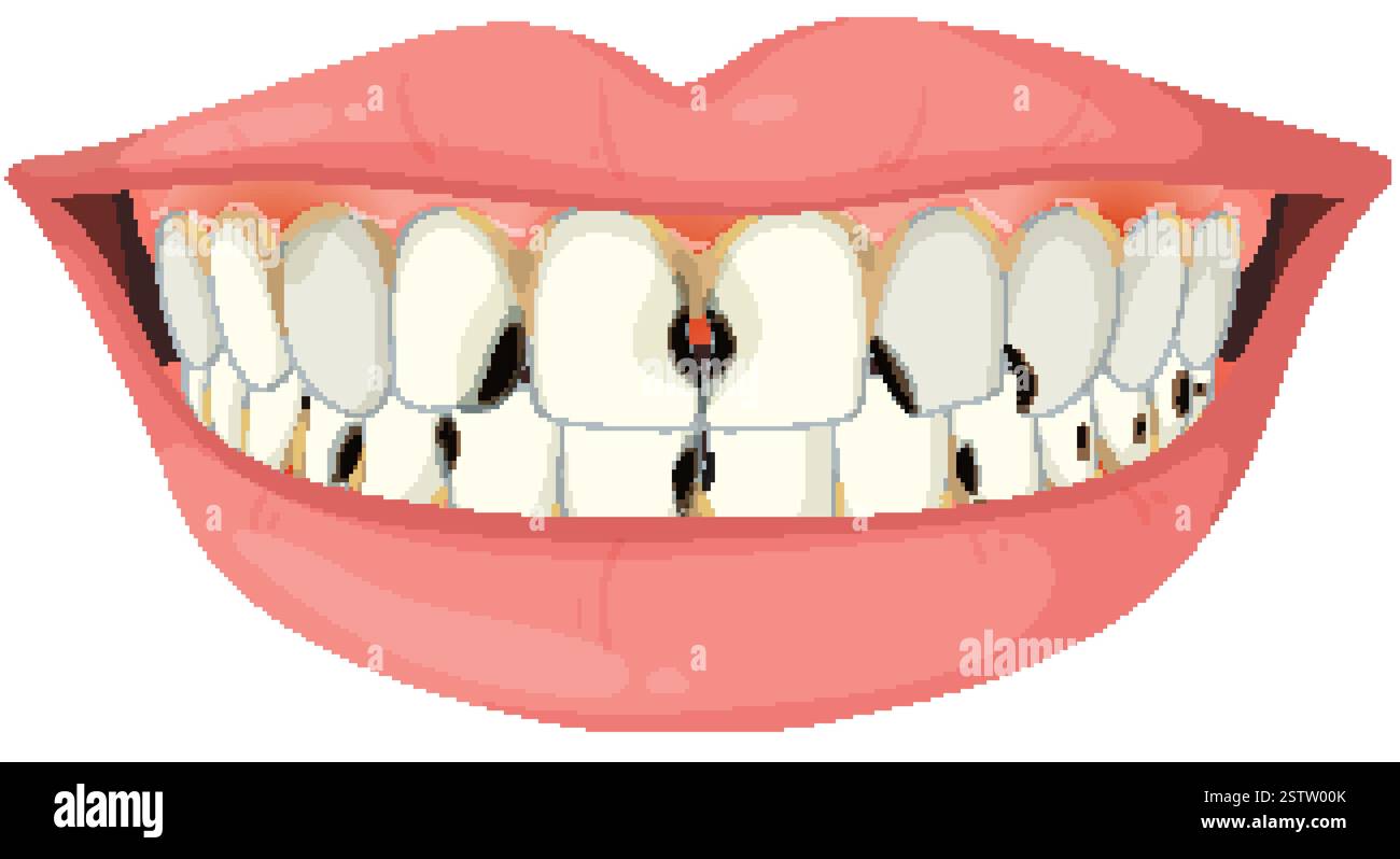 Vector showing teeth with visible decay and damage Stock Vector Image ...