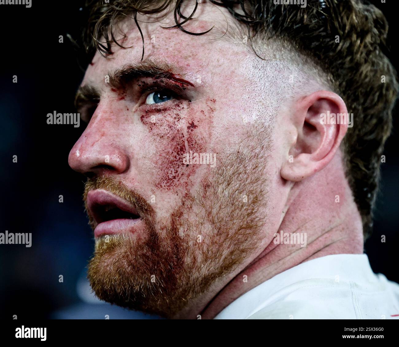 Ollie Chessum of England with a deep laceration to his left eye during the 2025 Guinness 6