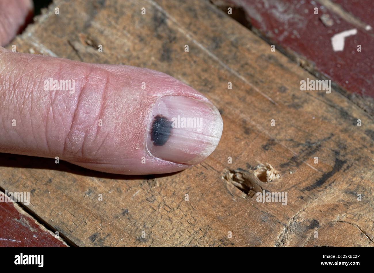 Subungual hematoma under nail hi-res stock photography and images - Alamy
