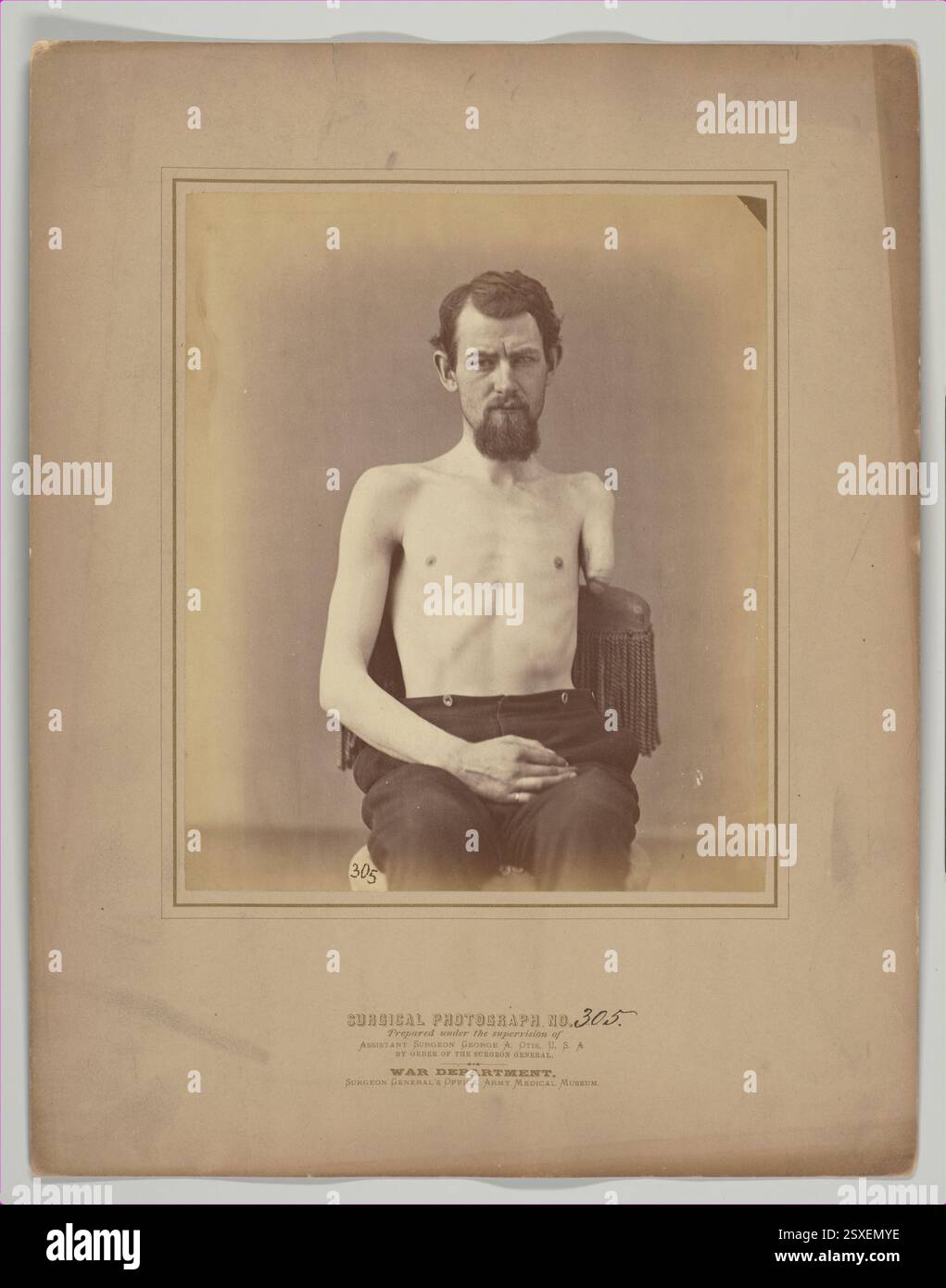 Photograph of a medical procedure showing the amputation of a soldier's left arm due to a gunshot injury, taken by E. J. Ward in 1871. This image starkly captures the realities of war and its medical challenges. Stock Photo