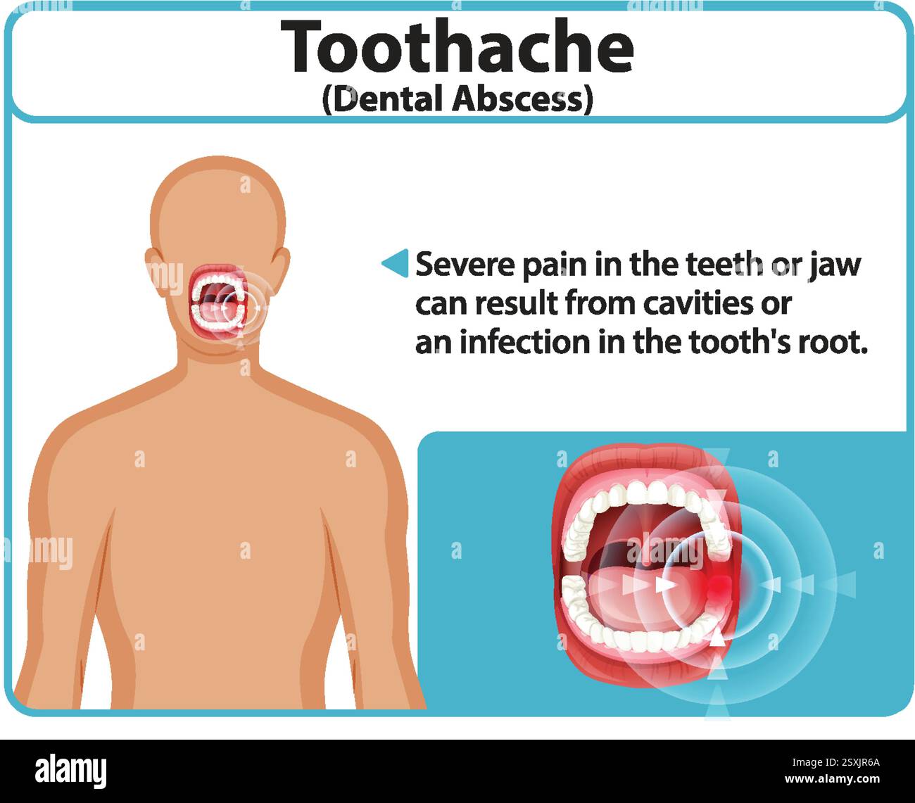 Illustration of toothache causes and symptoms Stock Vector Image & Art ...