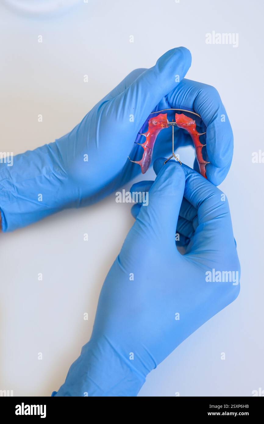 A palatal expander used in orthodontics to widen the upper or lower jaw Stock Photo