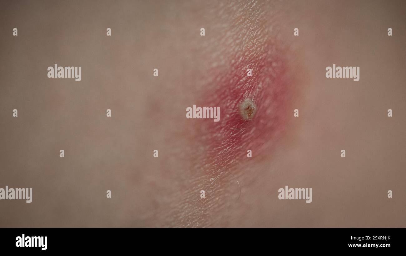 Infected and closed skin glands by staphylococcus. Bulge in skin due to ...