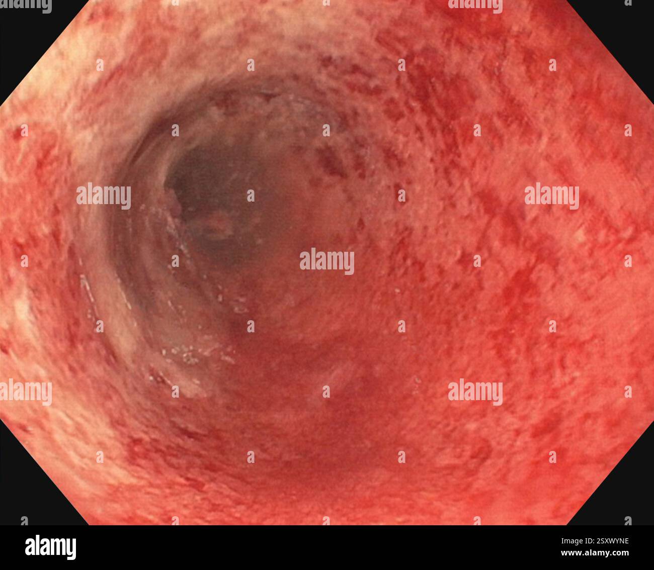 Endoscope view of the colon of a 45 year old female patient with ...