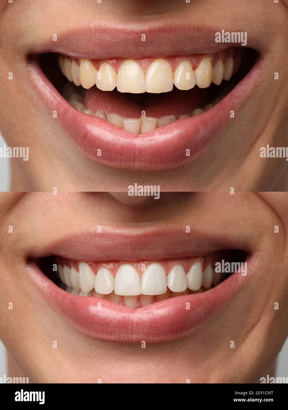 Man smiling before and after procedure dental veneers placement ...