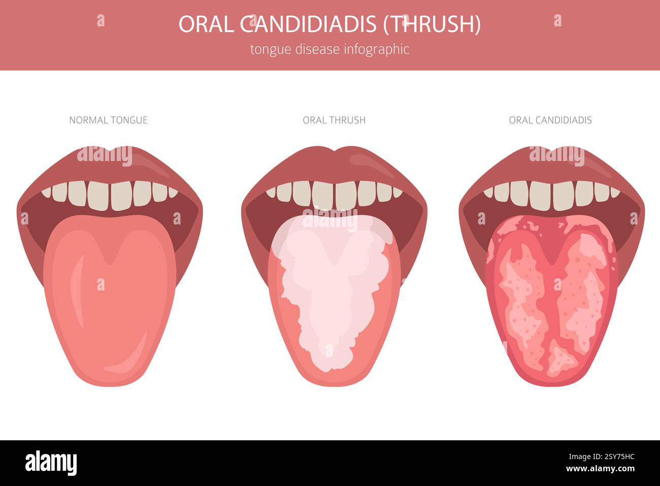 Oral Thrush Oral Candidiadis Disease Medical Infographic Design 