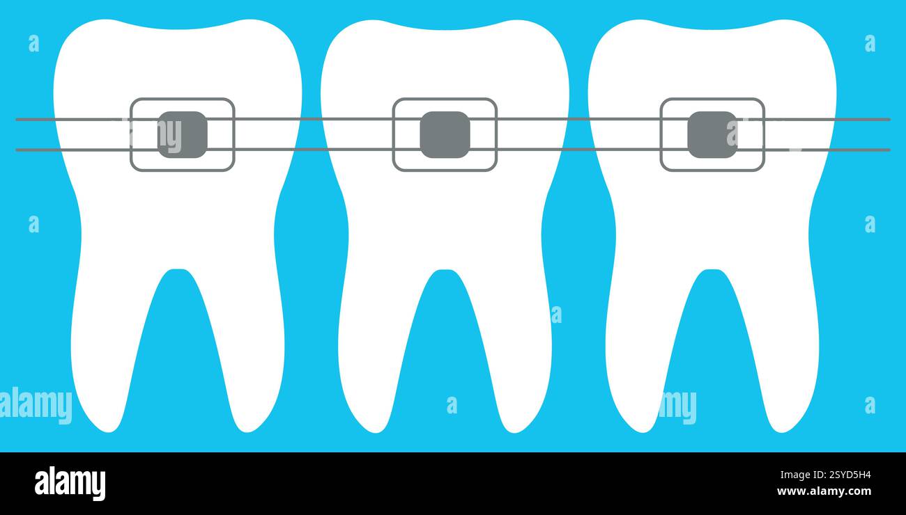 Illustration of Teeth with Braces for Orthodontic Treatment on Blue ...
