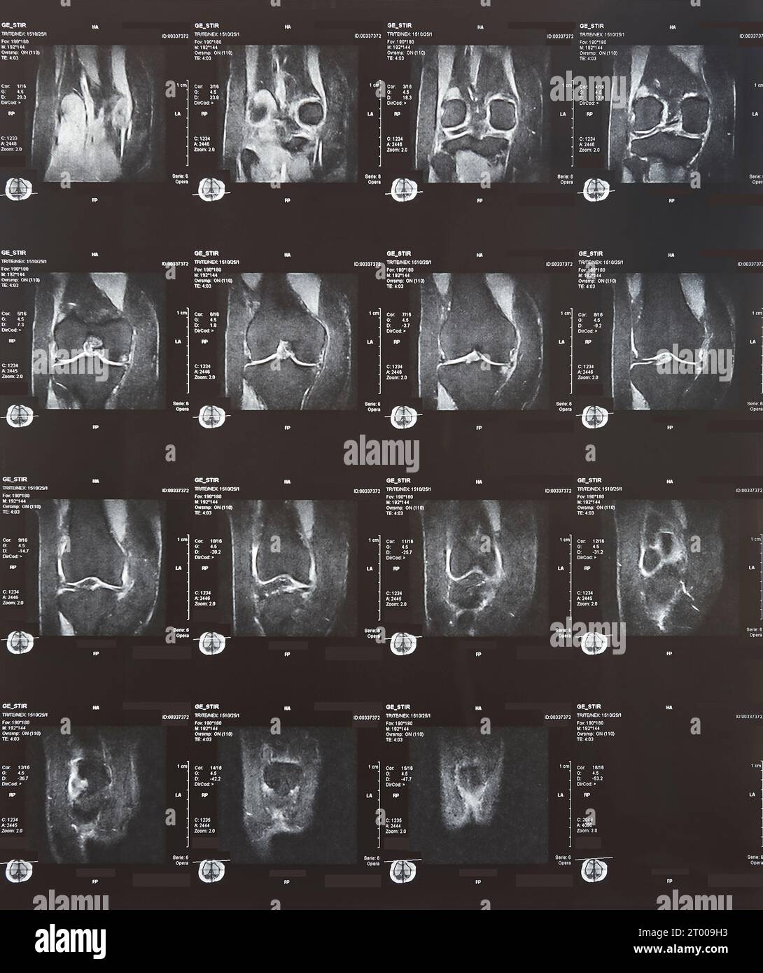 Knee cap resonance. Osteoarthritis. Articular cartilage and