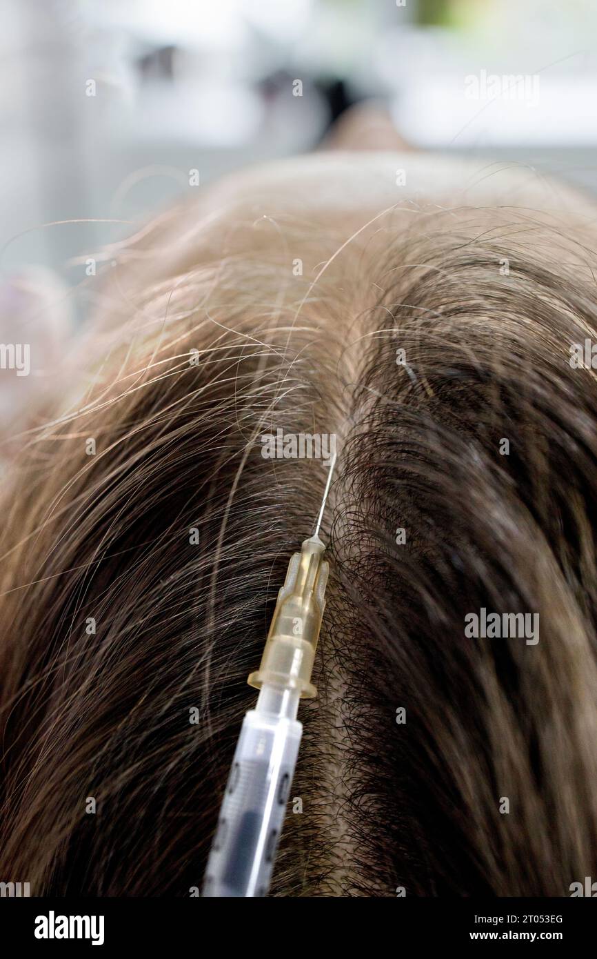 Closeup shot of plasma injections anti hair loss procedure. Young