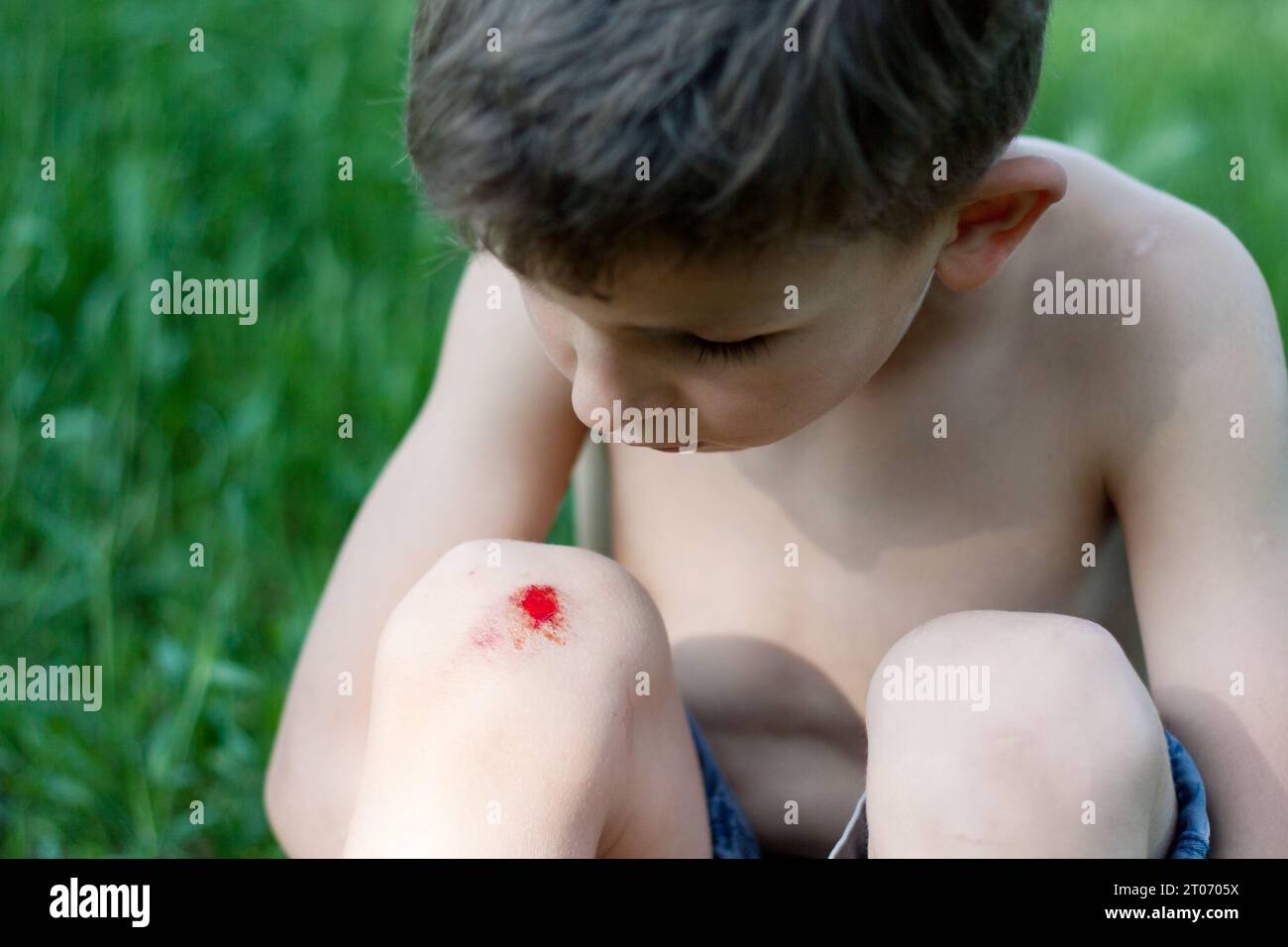 Portrait of preschool boy sitting on grass with fresh bleeding wound on knee. child fell, scratched skin on knee, hurt, upset. Children injuries in su Stock Photo