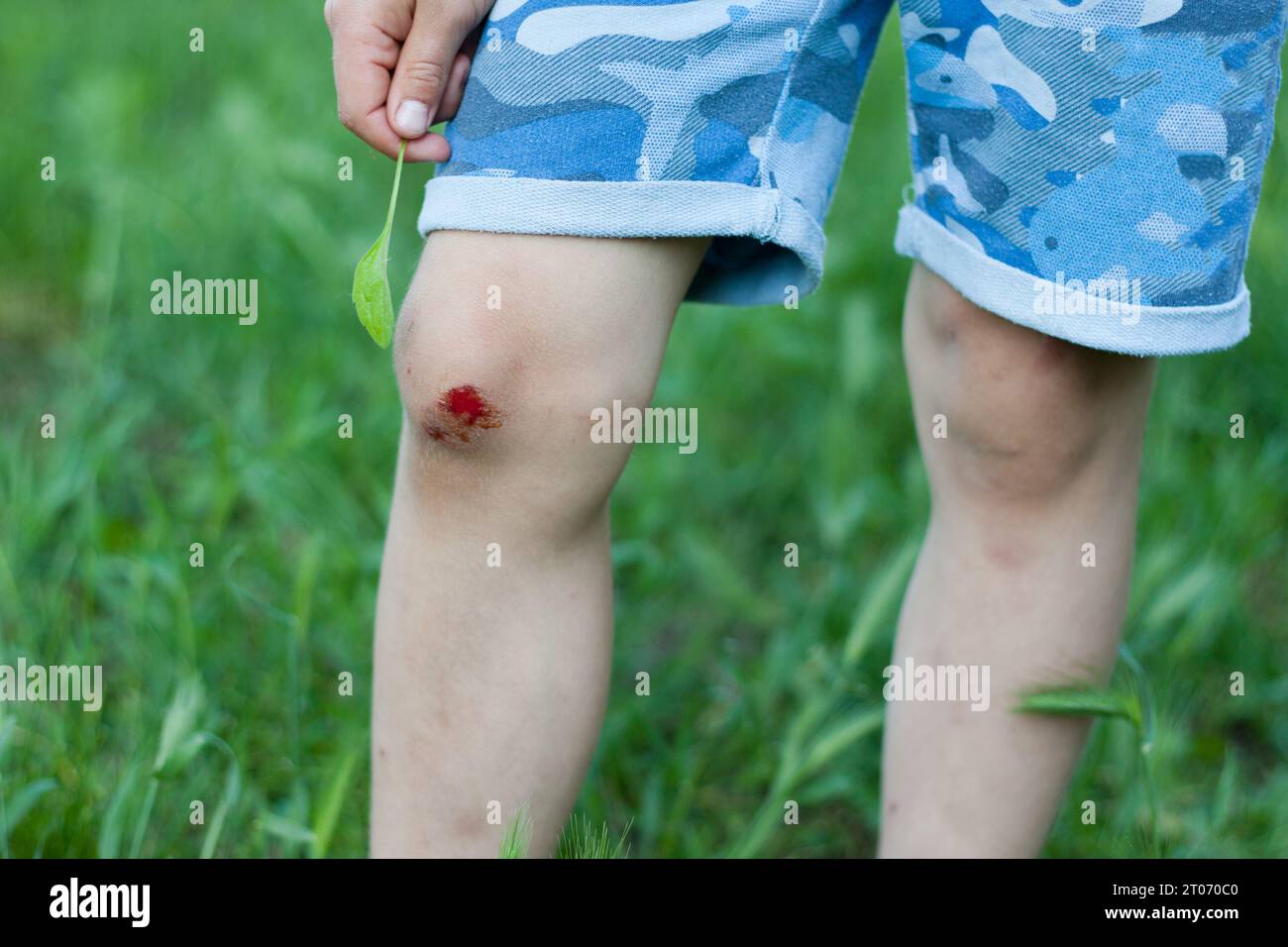 Closeup of fresh bleeding wound on child knee due to fall. Childhood ...