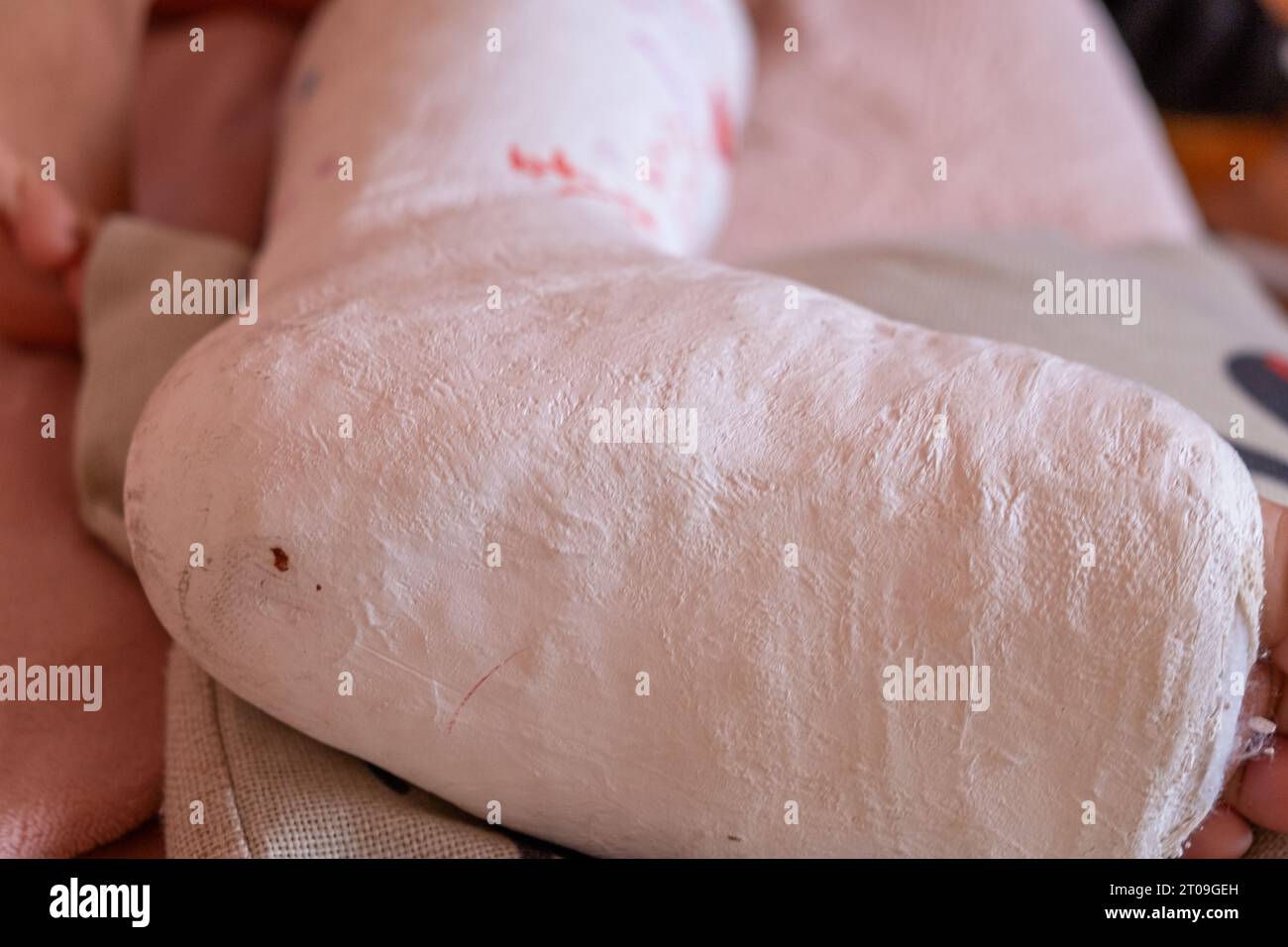 close-up view of a plastered leg Stock Photo