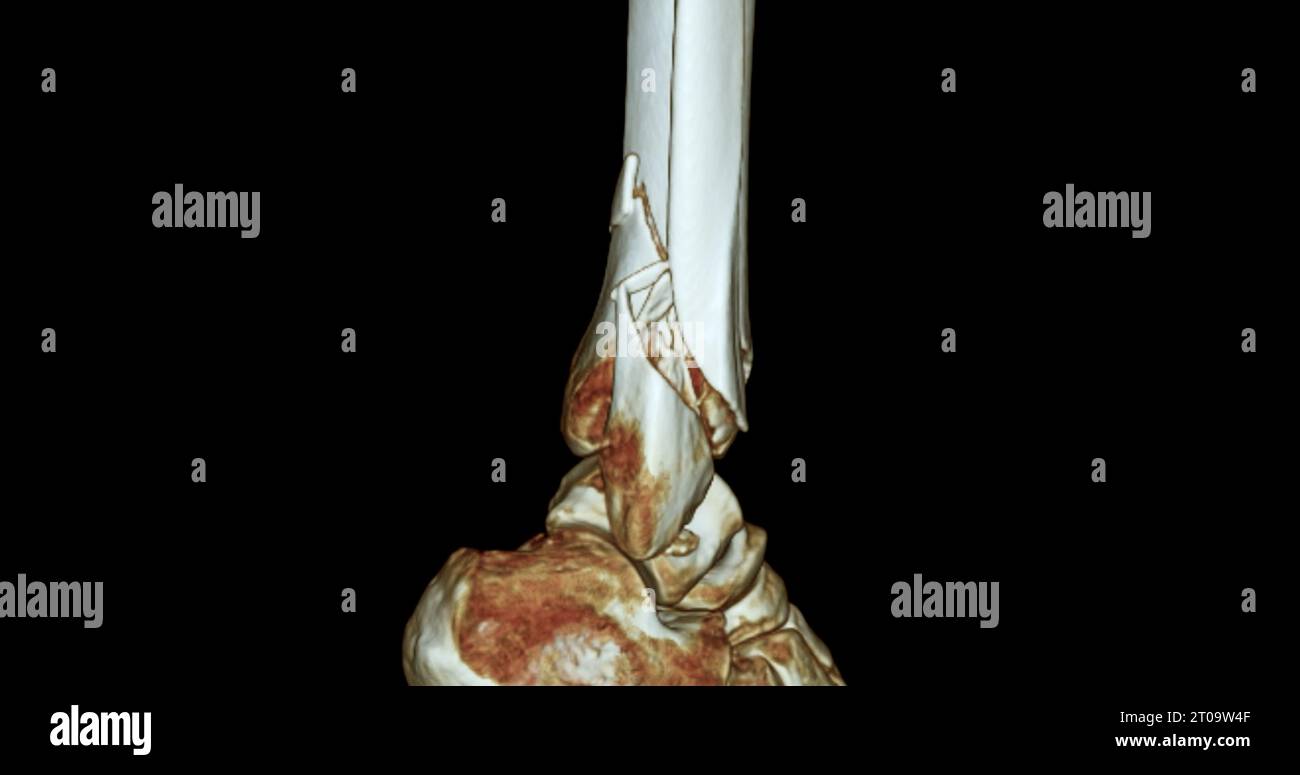 CT Scan ankle joint 3D Rendering image showing fracture tibia and ...