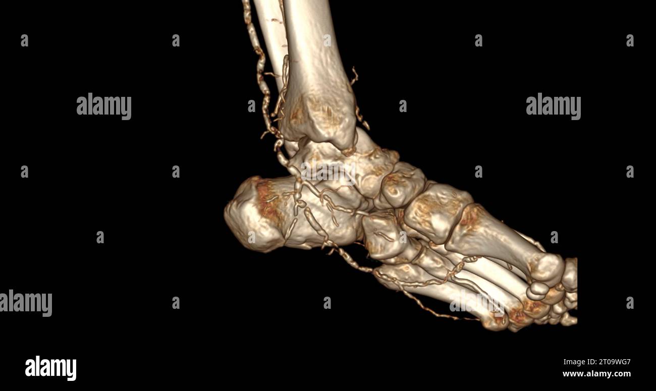 Foot 3D Scan For Diagnosis Foot Diseases By CT SCANNER Stock Photo Alamy foot-3d-scan-for-diagnosis-foot-diseases-by-ct-scanner-stock-photo-alamy