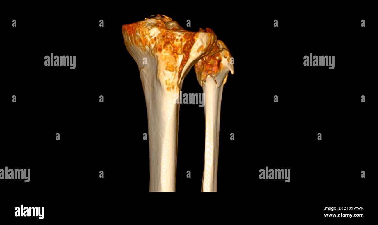CT Scan of Knee joint showing fracture tibia and fibula bone 3D ...